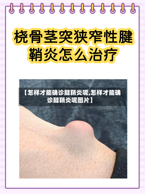 【怎样才能确诊腱鞘炎呢,怎样才能确诊腱鞘炎呢图片】