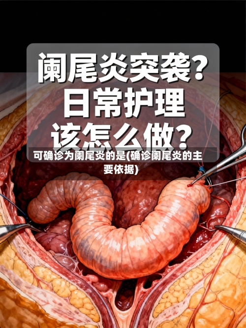 可确诊为阑尾炎的是(确诊阑尾炎的主要依据)-第2张图片