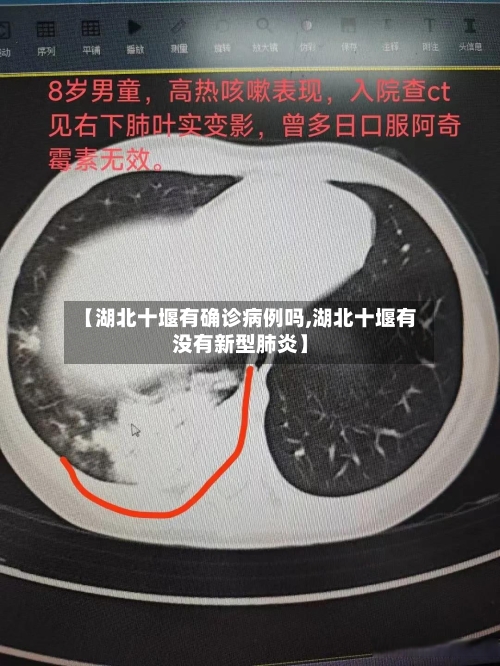【湖北十堰有确诊病例吗,湖北十堰有没有新型肺炎】